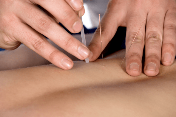 Wat is acupunctuur